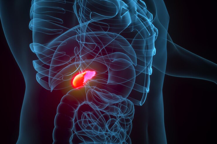 Cholecystitis