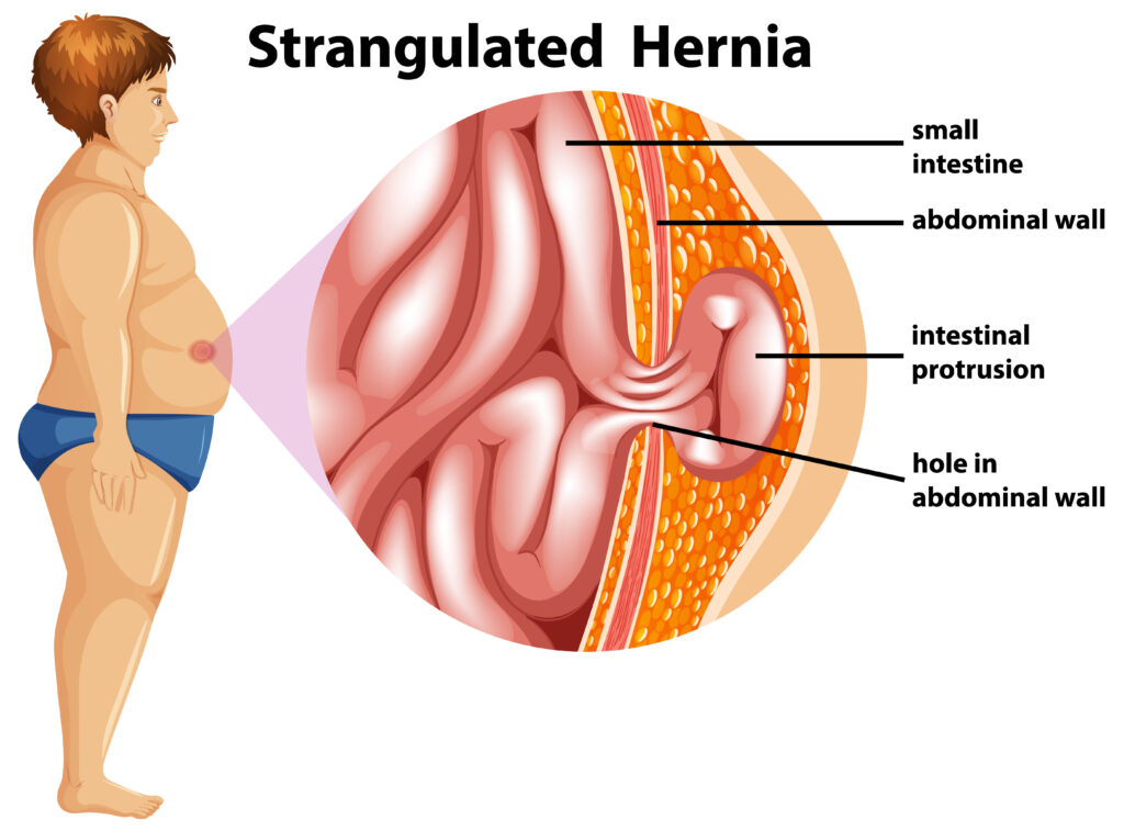 Hernias