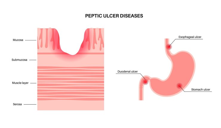 Perforated Ulcers