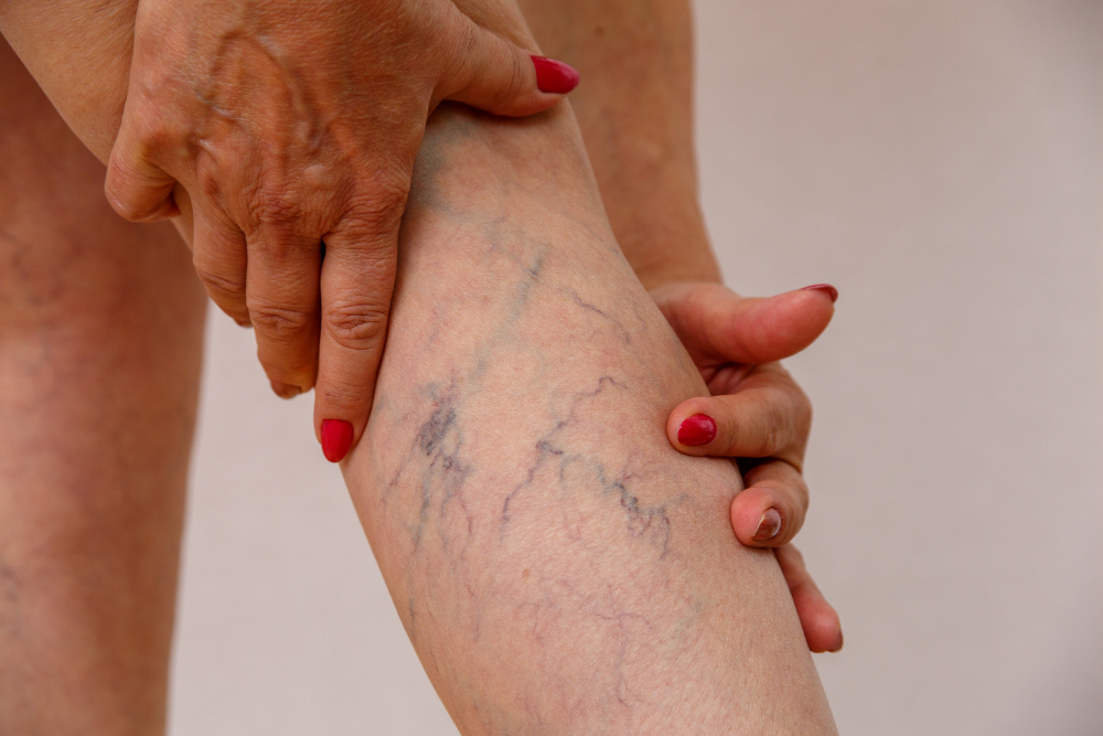 Varicose vein